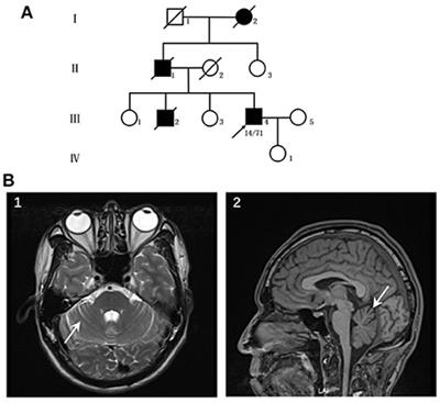 Frontiers Autonomic Dysfunction As The Initial Presentation In   967293 Thumb 400 